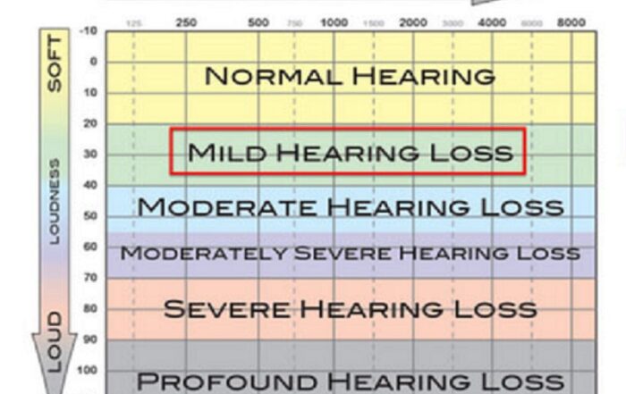 Mild Hearing Loss