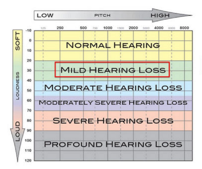 Mild Hearing Loss